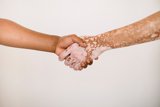 Foto de aperto de mãos entre uma pessoa sem vitiligo e outra com a doença