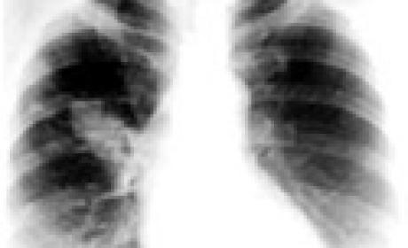 Artigo pode ser acessado na revista Cadernos de Saúde Pública, publicada pela Ensp (Imagem: Ensp) Radiografia de um pulmão