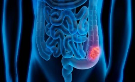 Imagem: Divulgação Imagem de computador simulando o tumor no local
