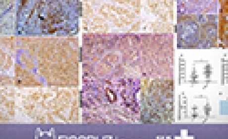 Imagem de células cancerígenas 