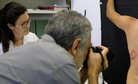 Photographer records skin lesion on project volunteer 