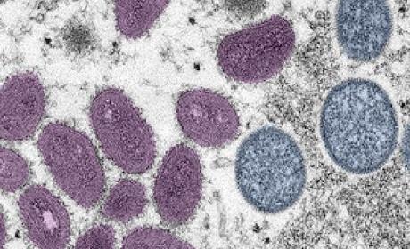 Foto: CDC Vírus monkeypox visto pelo microscópio