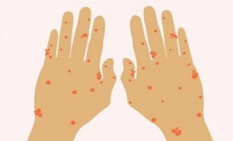 Imagem: Divulgação / MS Desenho de duas mãos com pintas causadas pela monkeypox