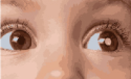 Imagem: IFF Olho de criança com retinoblastoma