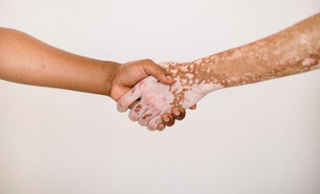 Foto: Pexel Foto de aperto de mãos entre uma pessoa sem vitiligo e outra com a doença